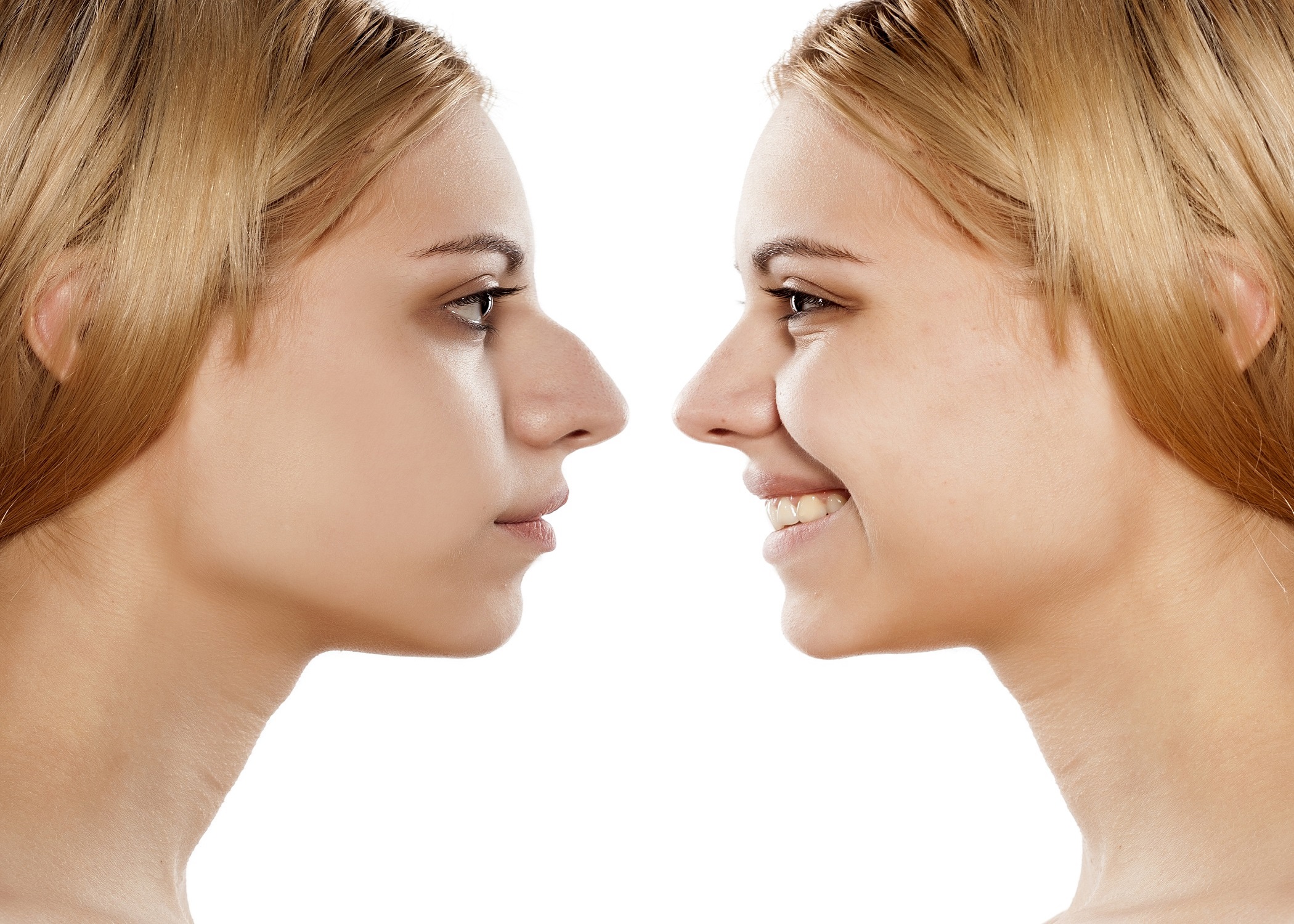 before and after rhinoplasty (nose job) surgery