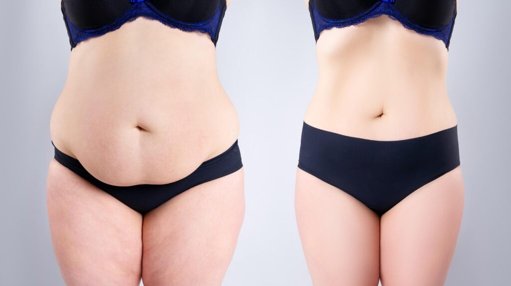 before and after tummy tuck surgery