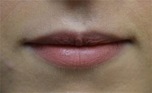 before and after lip augmentation