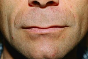 lip augmentation