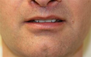 benefit of lip augmentation